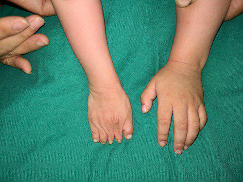 性的手发育不良,专业上叫五指的并指短指畸形,通俗点说,就是鸭蹼手