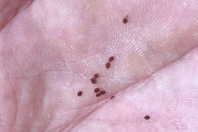 港人浴巾上现14粒"臭屁虫"卵 专家:其汁液或致敏