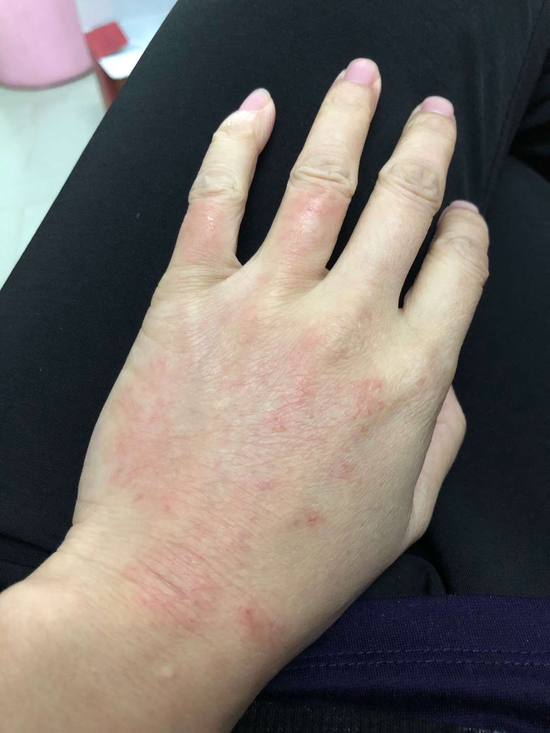 肾内科李瑛瑛护士频繁使用消毒液消毒后的手.