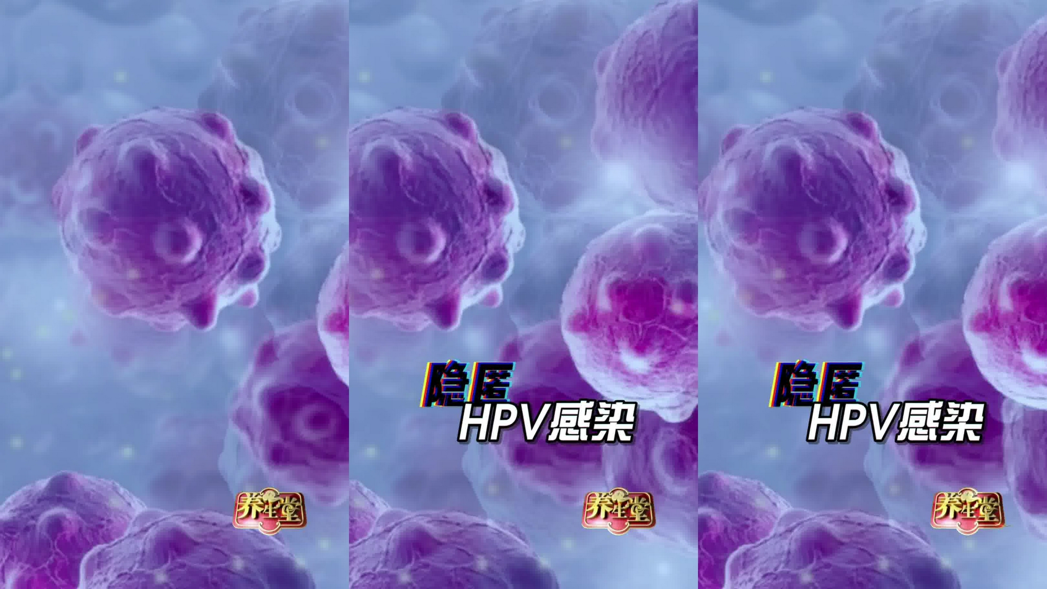医学科普 hpv 刘彦春 她hpv感染,以前是三级病变