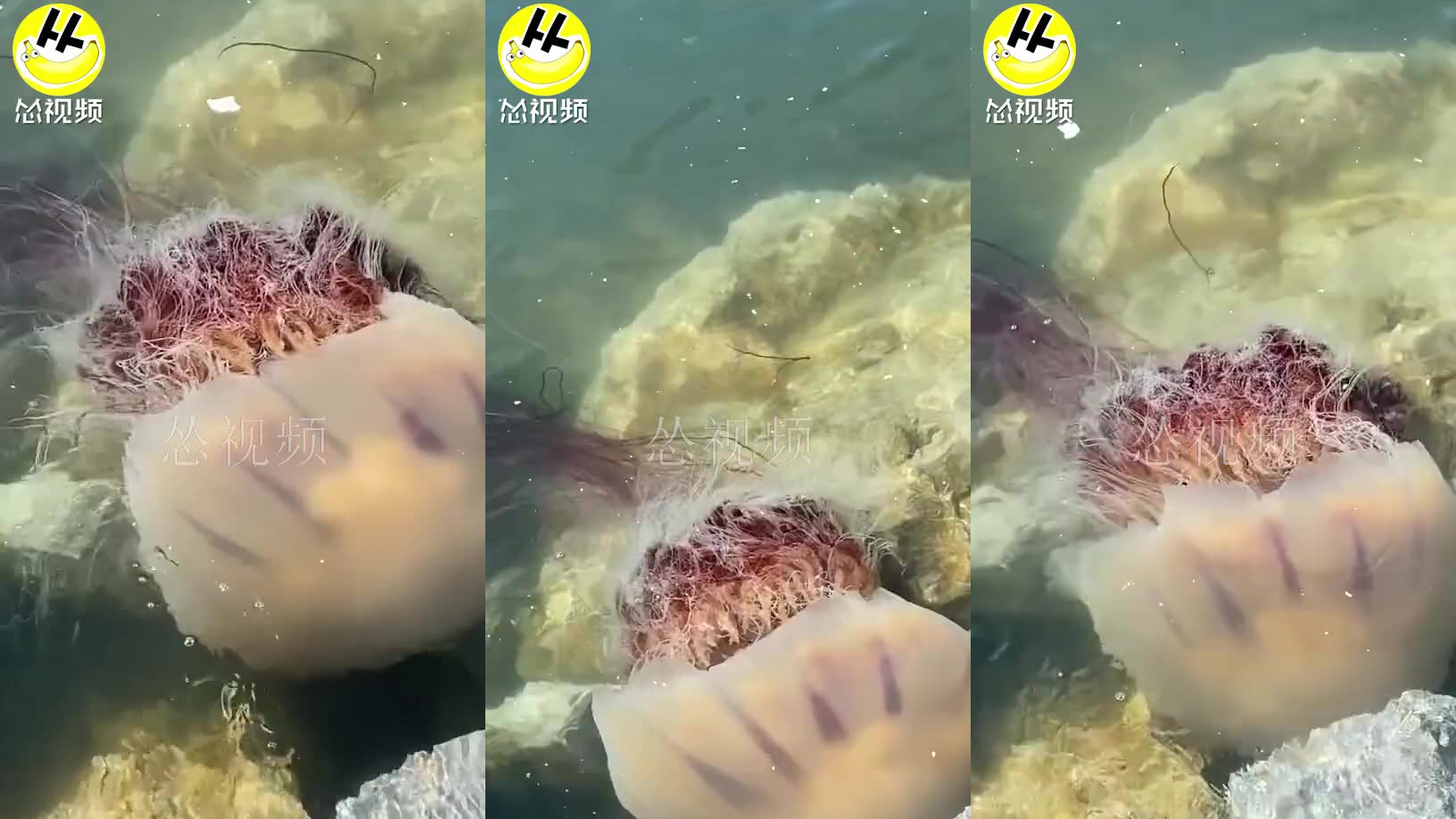 泉叔说事 女子被海蜇蜇伤 大腿肿胀如火腿