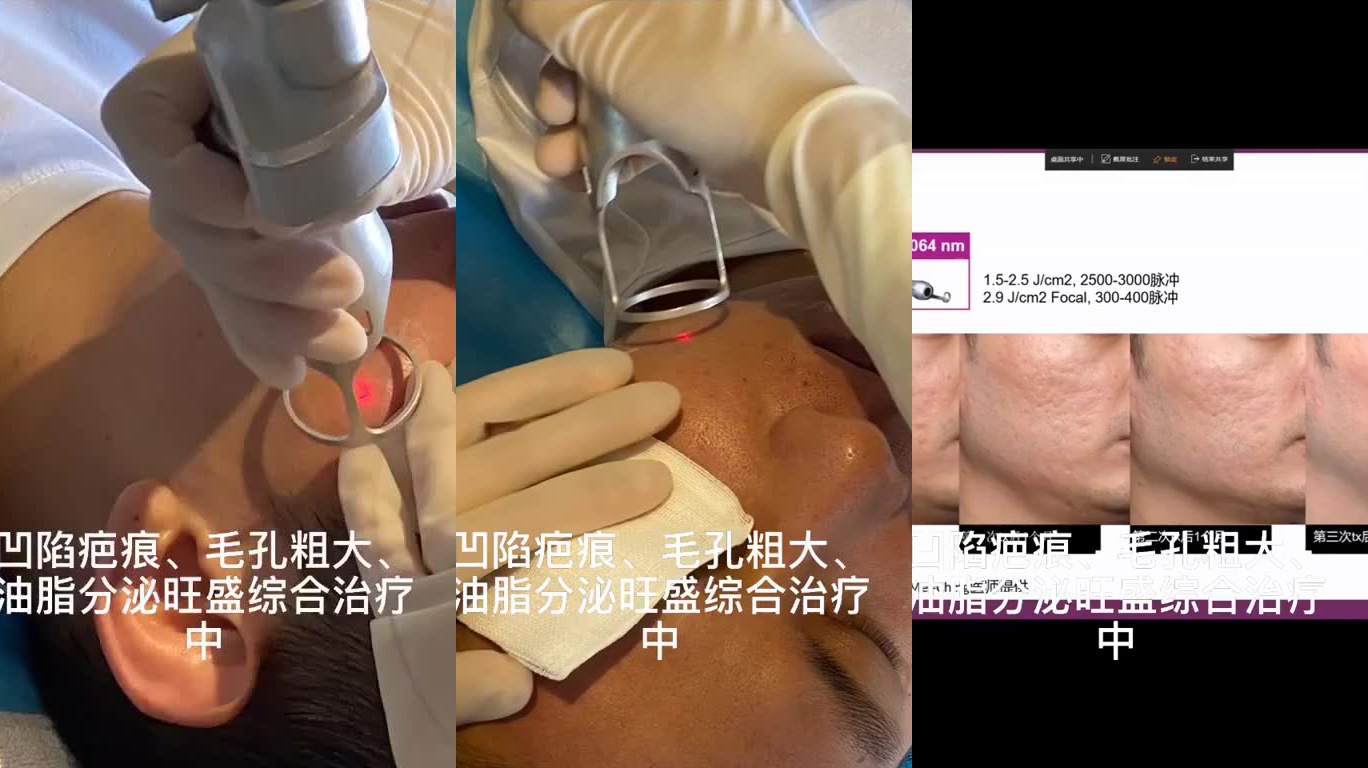 酒糟鼻能做光子嫩肤吗?