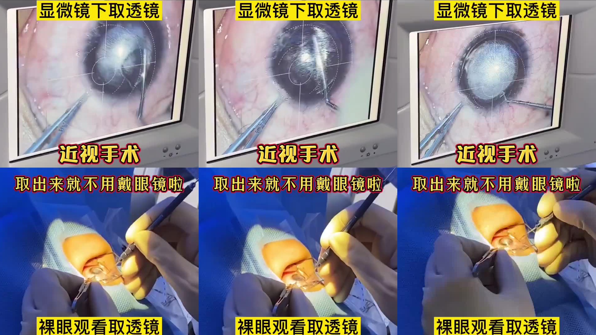这就是近视手术全飞秒取透镜的过程