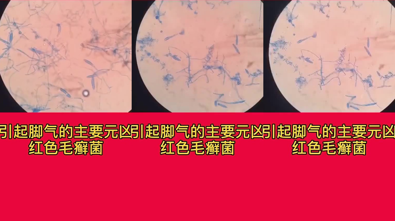 揭秘,引起脚气的元凶之一红色毛癣菌,太恐怖!