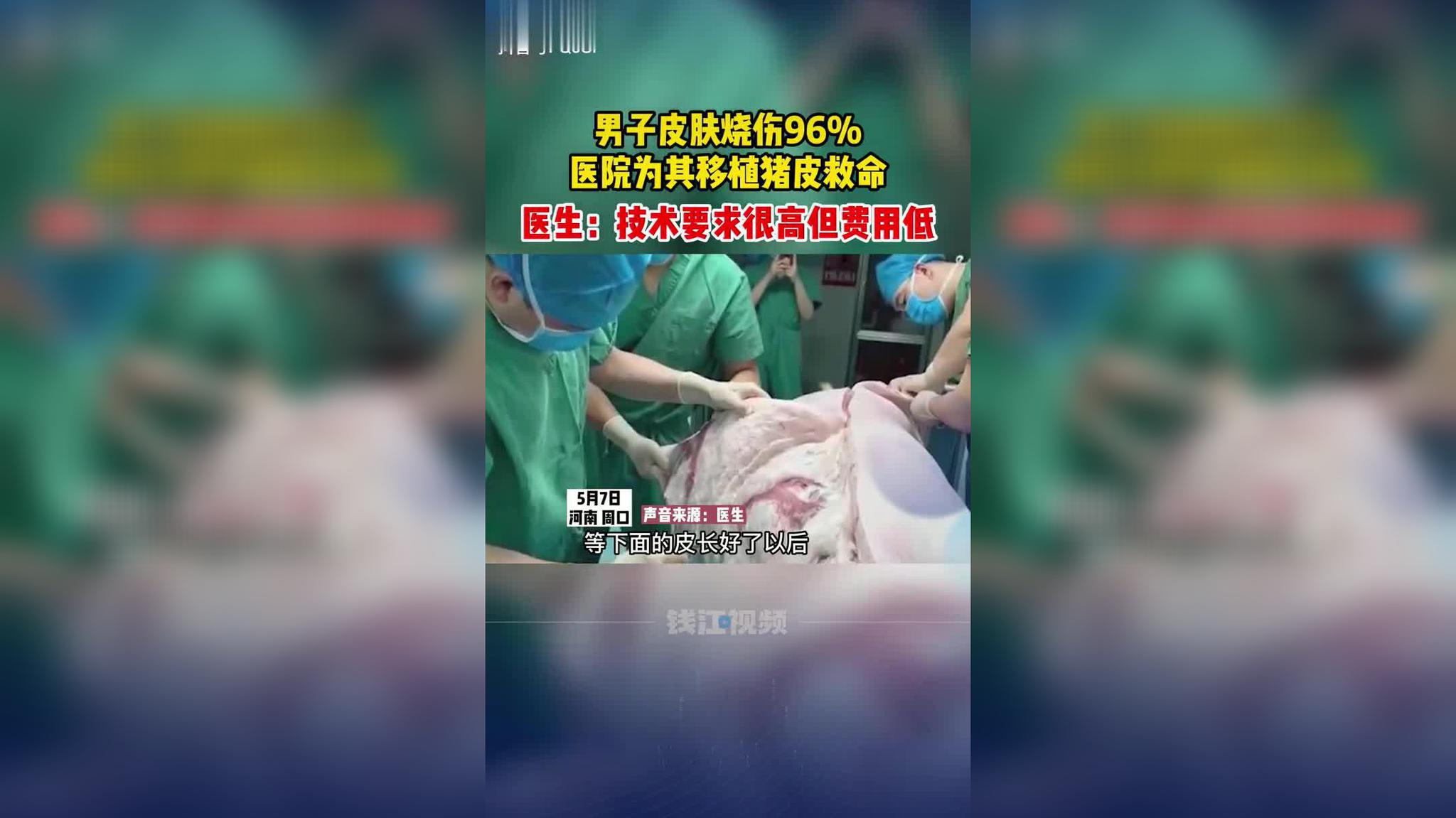 河南一男子皮肤烧伤96%,医院为其移植猪皮救命