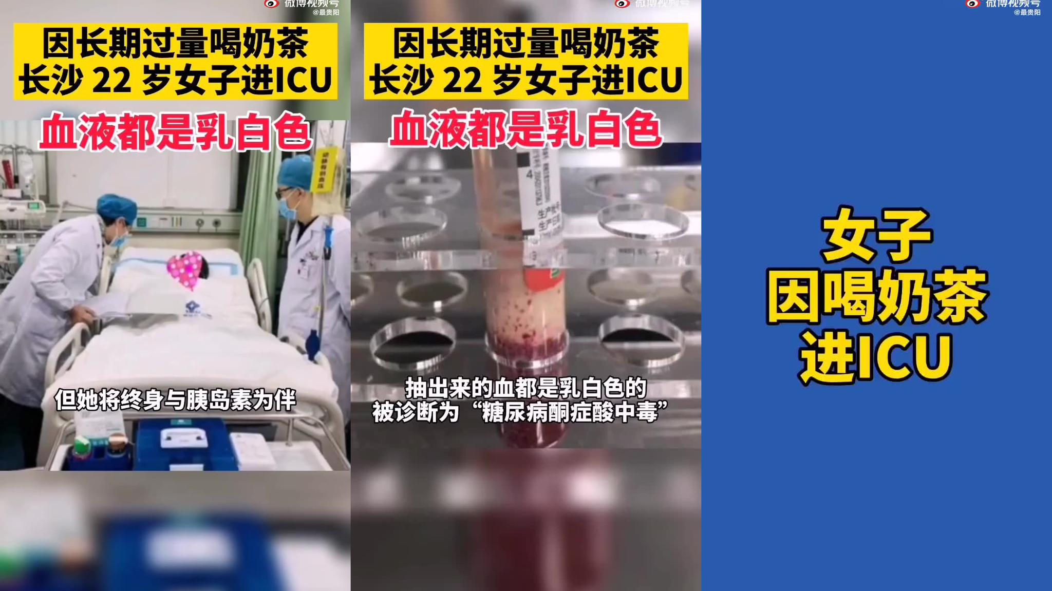 因长期过量喝奶茶,长沙22岁女子进icu!血液都是乳白色的