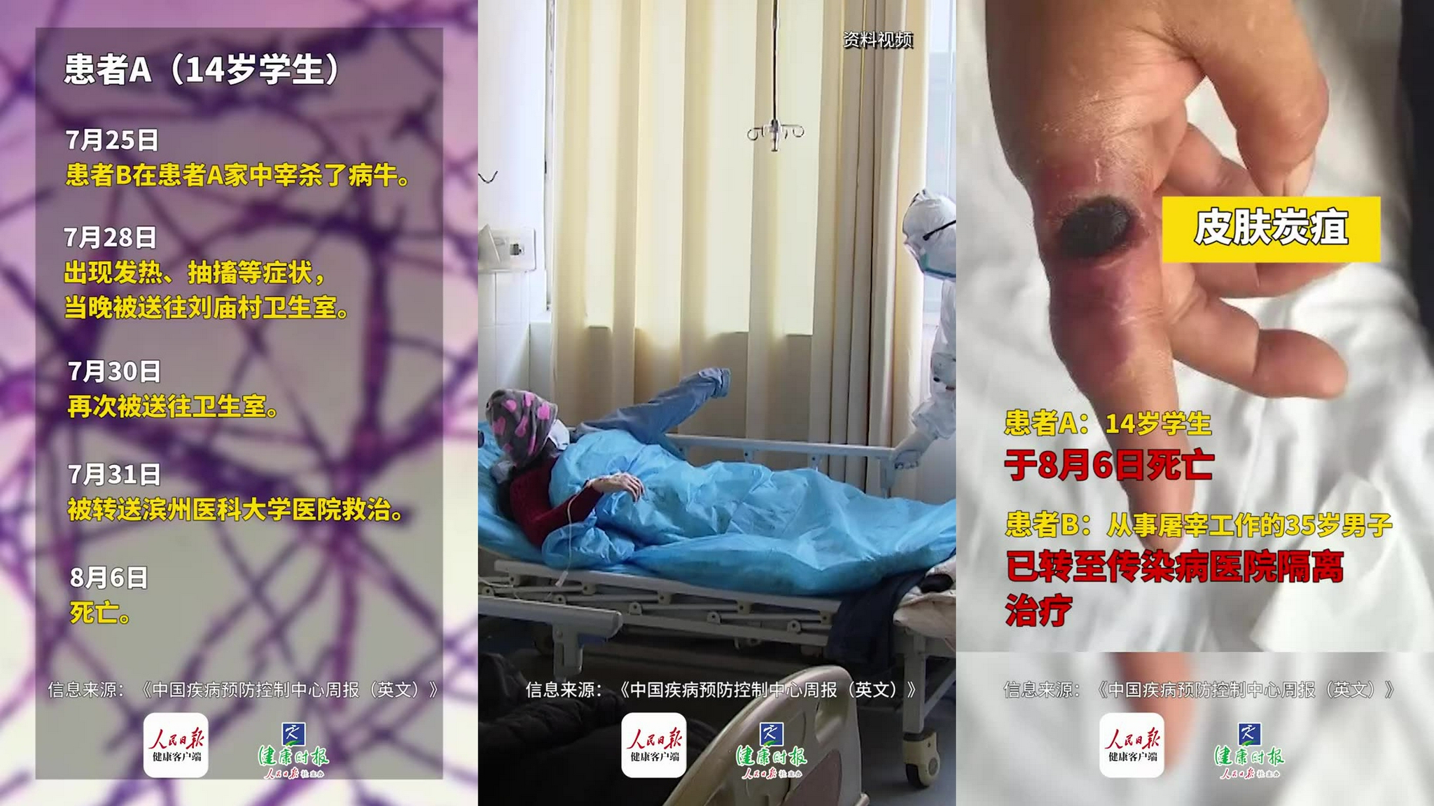 中疾控周报:山东省出现1例炭疽死亡病例