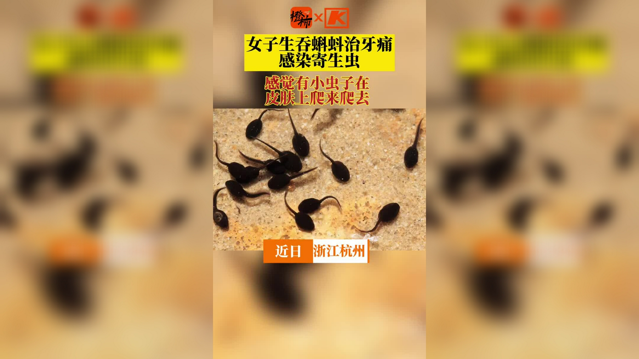 杭州女子生吞蝌蚪治牙痛感染寄生虫,称"感觉有小虫子在皮肤上爬来爬去