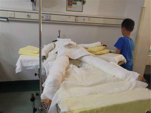 年仅10岁的婷婷全身缠满纱布趴在病床上