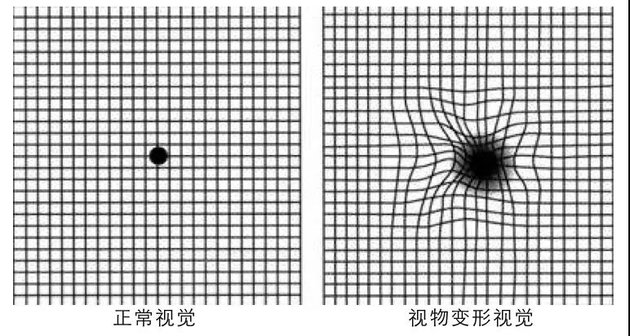 判断是否存在视物变形的简单方法是采用阿姆斯勒表(amsler),将其放在