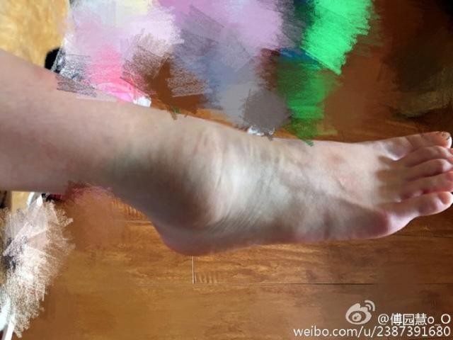 傅园慧夺首金打脸,练到缺氧摔断脚,倒数第1见鬼去!