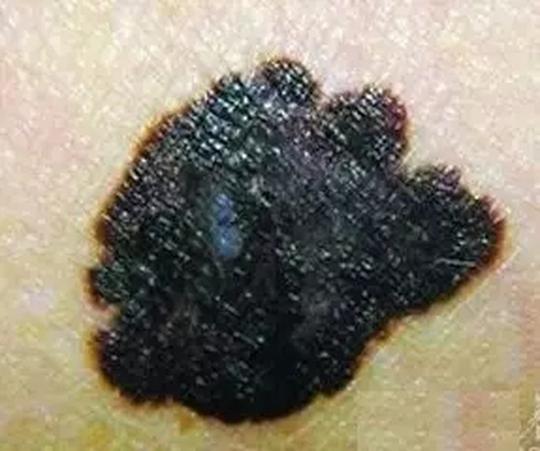 点击此处添加图注内容(恶性黑色素瘤)2)边缘是否规则普通痣的边缘光滑