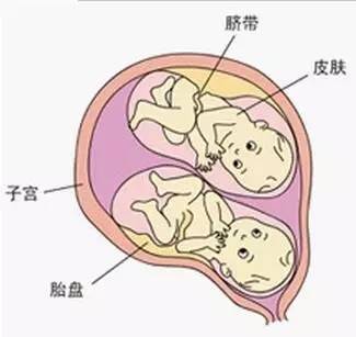 双胞胎顺产最佳胎位图图片