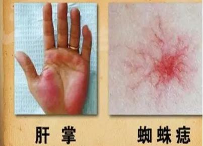 肝病早期会出现的症状 乙肝指标阴转慎停药!