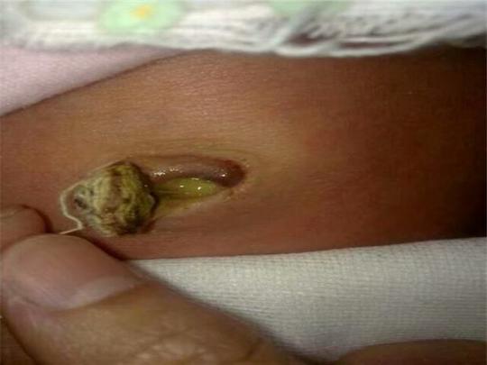 五,新生儿脐炎一般新生儿脐带4-10天干脱,脐炎是指:因断脐消毒不好