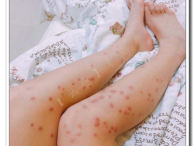 女生穿网袜开心的出去玩腿痒痒的晚上美腿肿成蜂窝