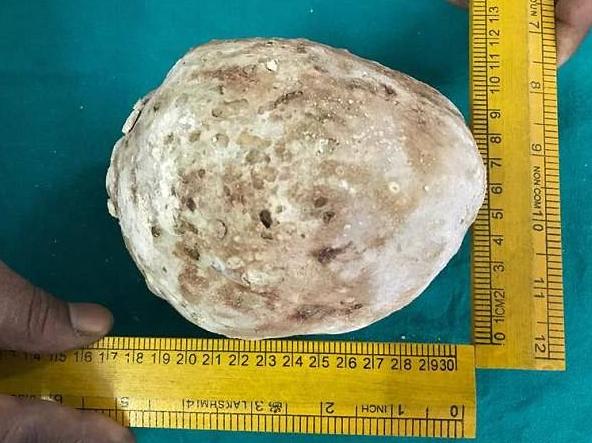印度男子腹痛入院,膀胱取出1.5公斤巨型结石