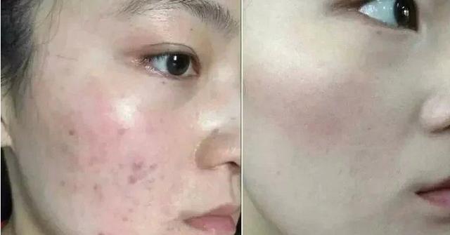 是这样解救痘痘肌肤,改善痘痘问题的