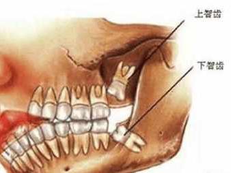 长智齿牙龈肿痛能拔吗 智齿拔后如何护理