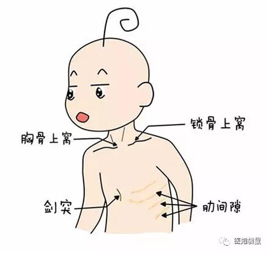 宝宝嗓子里总是有痰音 是支气管炎或肺炎征兆 宝宝嗓子里总是有痰音 是支气管炎或肺炎征兆