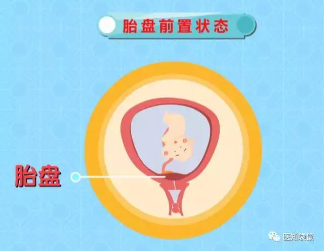 4,宫外孕的几率增加人工流产后,再次妊娠时宫外孕的风险会明显增加.