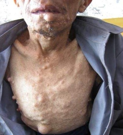 肢体麻木,头疼,小心犯了这病,特别是40岁以上的人