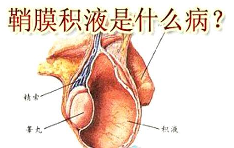 除了小儿疝气之外,还有一种病叫小儿鞘膜积液!