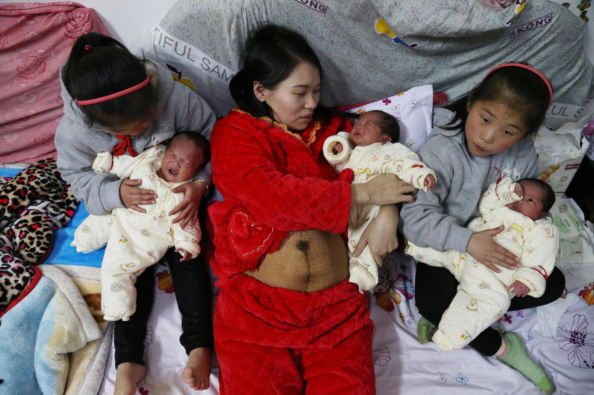 女子两次怀孕生下5个孩子,肚子如同焉气的气球!