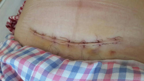 孕妇肚子上长满毛毛剖腹产丈夫嫌疤痕提离婚