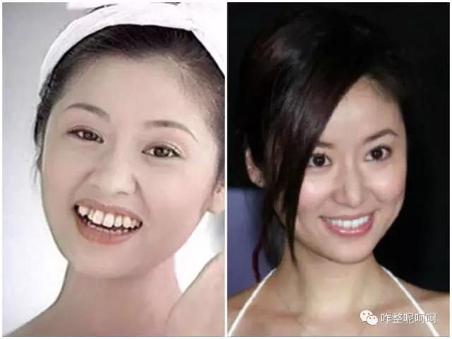 范冰冰从兔子一样的大门牙变成了整齐划一,排列有序的美牙娱乐圈整牙