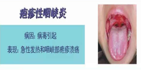 警惕!幼儿园孩子集体发烧 可能是疱疹性咽峡炎