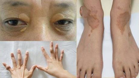 血脂高的人,身体如果出现这些情况,请尽快去医院