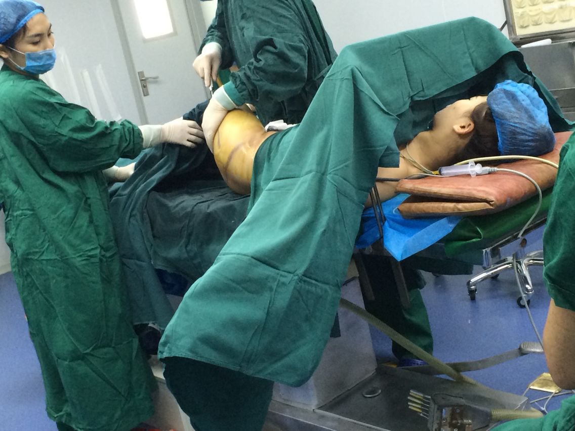 吸脂减肥手术对年龄有限制要求吗?