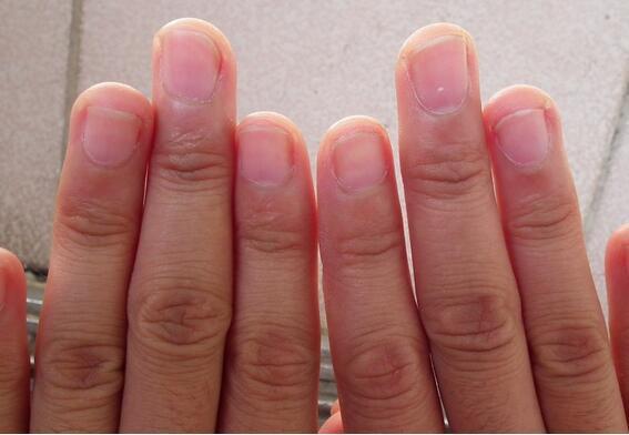 缺乏维生素a导致你的指甲出现条纹症状的最直接原因之一,就是你的