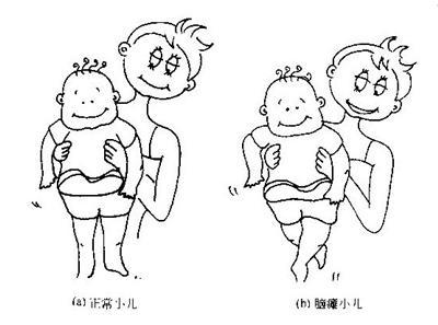 小儿脑瘫,又称小儿脑性瘫痪,不是一种独立的疾病,脑瘫是指从出生后一