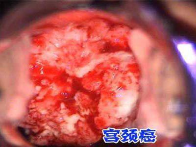 宫颈癌防治新进展