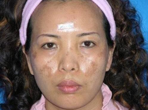 快速自检肝功能异常的5大表现