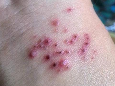 为什么嘴上起疱疹？