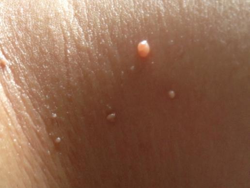 皮肤上长小肉疙瘩怎么去除_脖子上的小肉球很难看教你几招