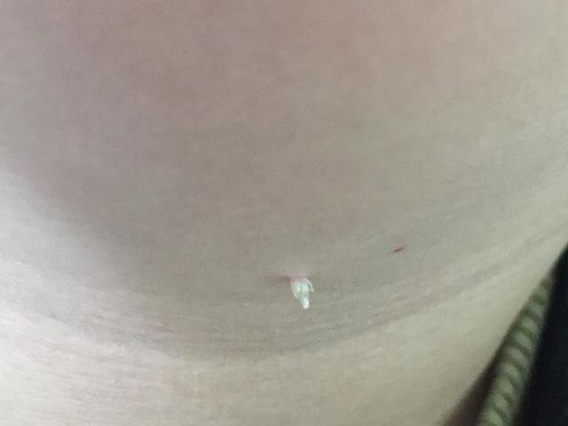 皮赘是一种皮肤软纤维瘤,千万不要再耽误病情