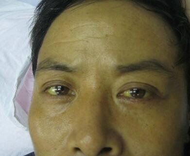 脸色蜡黄,皮肤粗糙,也是肝病面容.