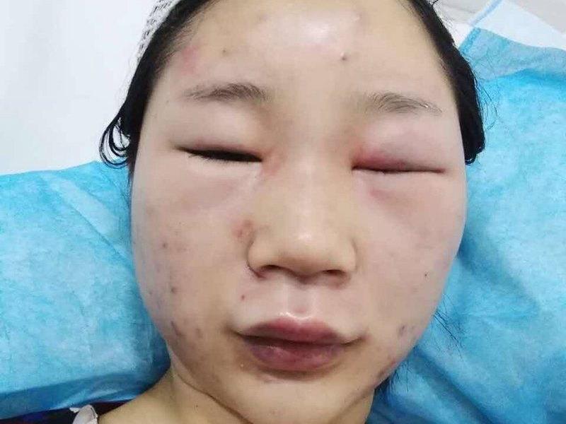华师女生昆明旅游被陌生人殴打 鼻青脸肿头部缝了6针