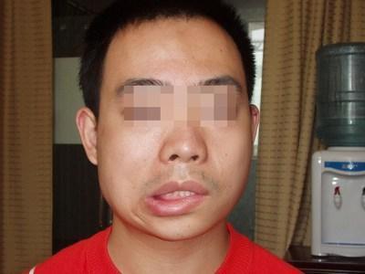 小伙子一觉醒来嘴歪眼斜,就因为没注意一件小事!