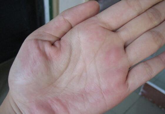 手掌如果是这种颜色那么当心你患上了肝病