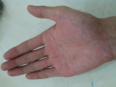 手掌如果是这种颜色那么当心你患上了肝病