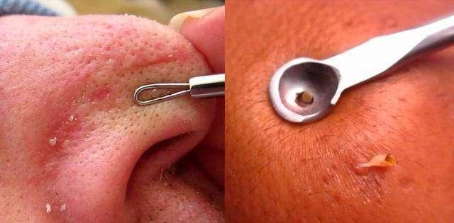 鼻旁有洞就麻烦了,消灭黑头要这样做!