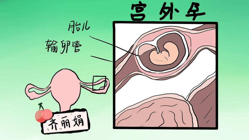 怀孕6周被宣判宫外孕,需切除一侧输卵管,怎么避免