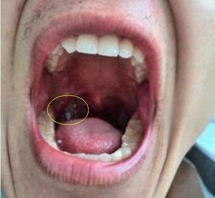 打喷嚏时飞出一个小颗粒原来是扁桃体结石怎么治