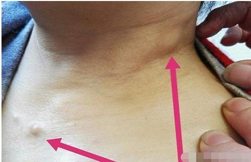 脖子上不仅有很多重要的血管流经,同时也是淋巴聚集的部位,因此脖子