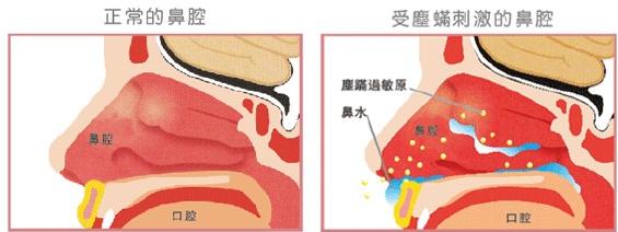 过敏性鼻炎|迎香穴|鼻腔_新浪新闻